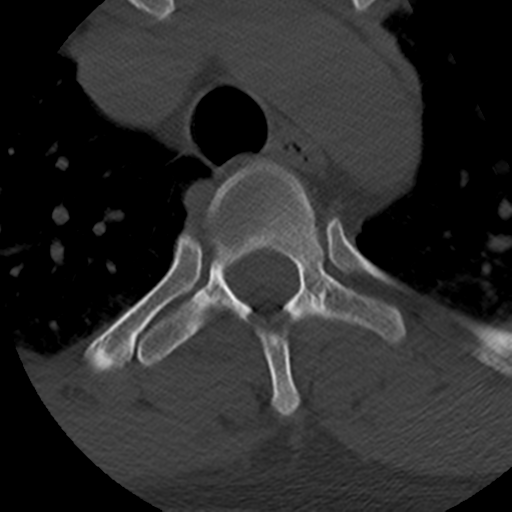 File:Cervical schwannoma (Radiopaedia 57979-64974 Axial bone window 55).png