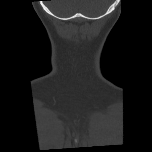 Cervical schwannoma (Radiopaedia 57979-64974 Coronal bone window 57).png