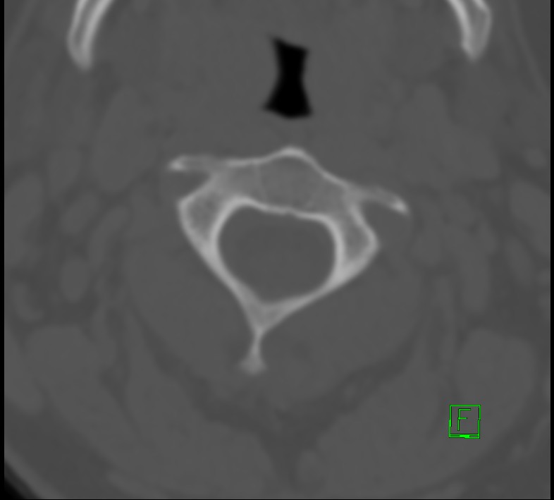 Cervical spine fracture - hyperflexion injury (Radiopaedia 66184-75364 Axial bone window 7).jpg