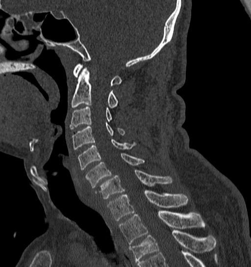 File:Cervical spine trauma with tear drop fracture and perched facet joint (Radiopaedia 53989-60127 Sagittal bone window 76).jpg
