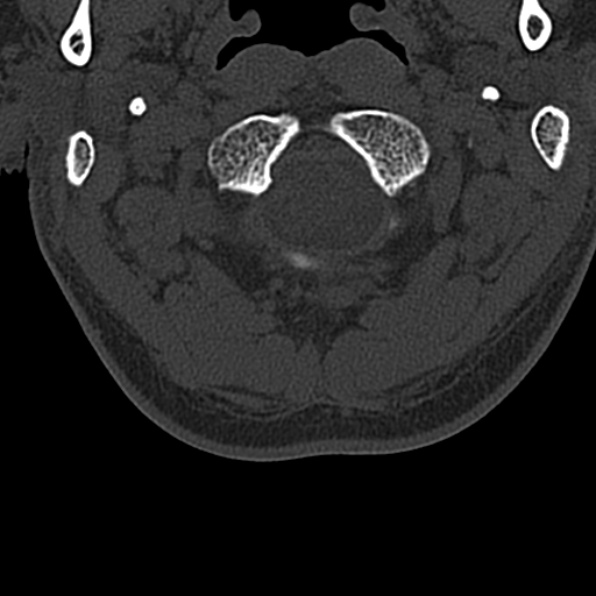 Cervical spondylodiscitis (Radiopaedia 28057-29489 Axial bone window 14).jpg