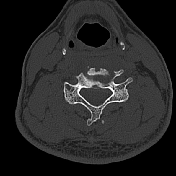 Cervical spondylodiscitis (Radiopaedia 28057-29489 Axial bone window 45).jpg