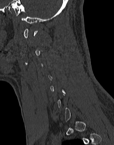 Cervical spondylodiscitis (Radiopaedia 28057-29489 Sagittal bone window 49).jpg
