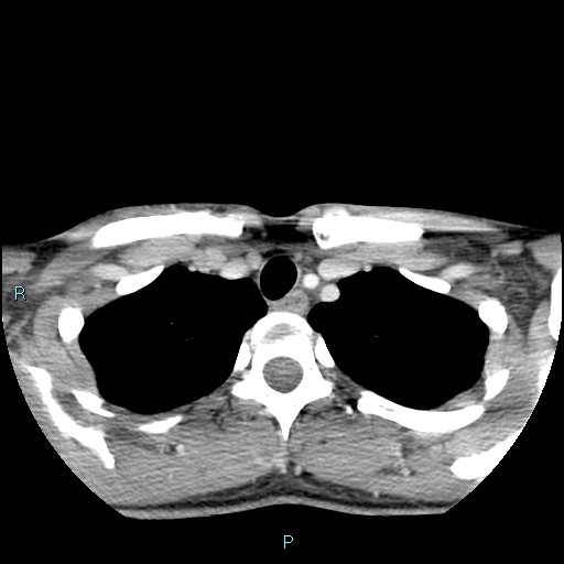 Cervical thymic cyst (Radiopaedia 88632-105335 C 23).jpg