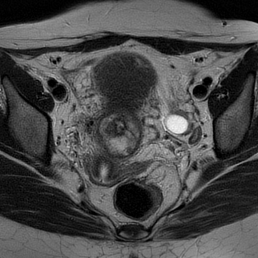 File:Cesarean scar ectopic pregnancy (Radiopaedia 77286-89362 Axial T2 22).jpg