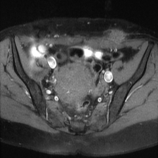 File:Cesarian section scar endometriosis (Radiopaedia 66520-75799 Axial T1 fat sat 9).jpg