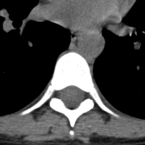 File:Chance fracture (Radiopaedia 36521-38081 Axial non-contrast 12).jpg
