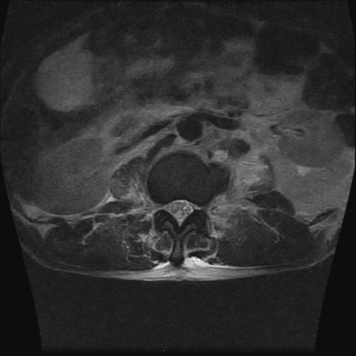File:Chance type fracture (Radiopaedia 31020-31725 Axial T2 3).jpg