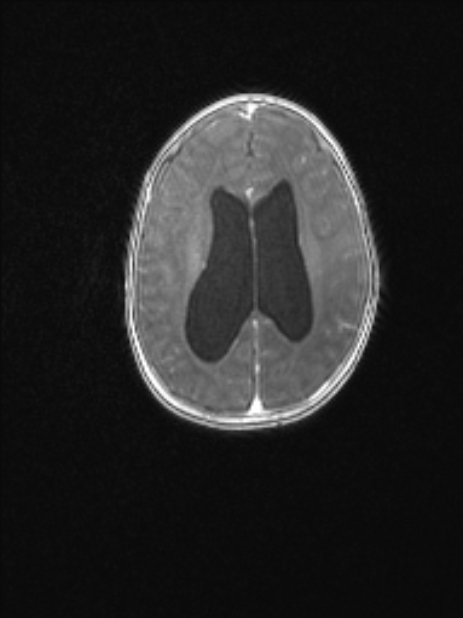 Chiari III malformation with occipital encephalocele (Radiopaedia 79446-92559 Axial T1 C+ mpr 60).jpg