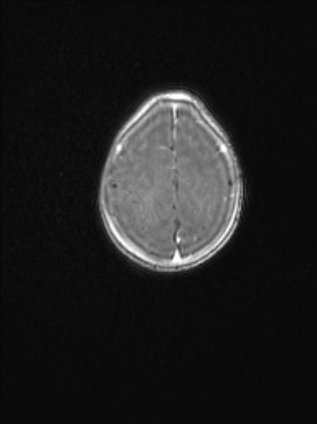 Chiari III malformation with occipital encephalocele (Radiopaedia 79446-92559 Axial T1 C+ mpr 71).jpg