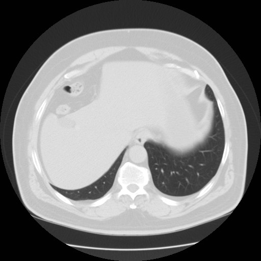 File:Chilaiditi’s syndrome (Radiopaedia 27550-27756 Axial lung window 19).jpg