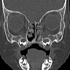 Choanal atresia (Radiopaedia 88525-105975 Coronal bone window 36).jpg