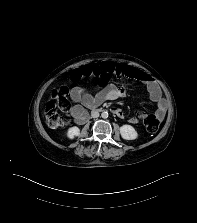 Cholangiocarcinoma with cerebral metastases (Radiopaedia 83519-98629 Axial C+ delayed 62).jpg