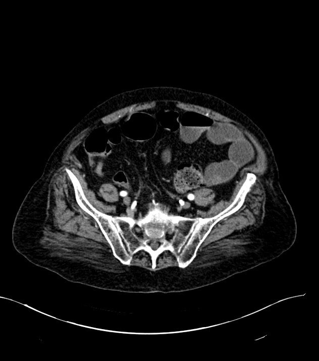 Cholangiocarcinoma with cerebral metastases (Radiopaedia 83519-98629 B 94).jpg