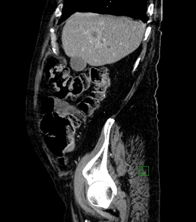 Cholangiocarcinoma with cerebral metastases (Radiopaedia 83519-98629 F 94).jpg