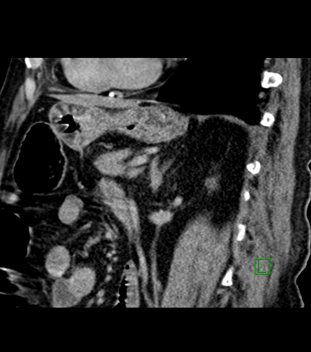 Cholangiocarcinoma with cerebral metastases (Radiopaedia 83519-98629 Sagittal C+ delayed 44).jpg