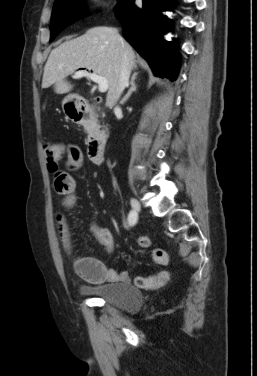 Cholecystoduodenal fistula due to calculous cholecystitis with gallstone migration (Radiopaedia 86875-103077 F 36).jpg