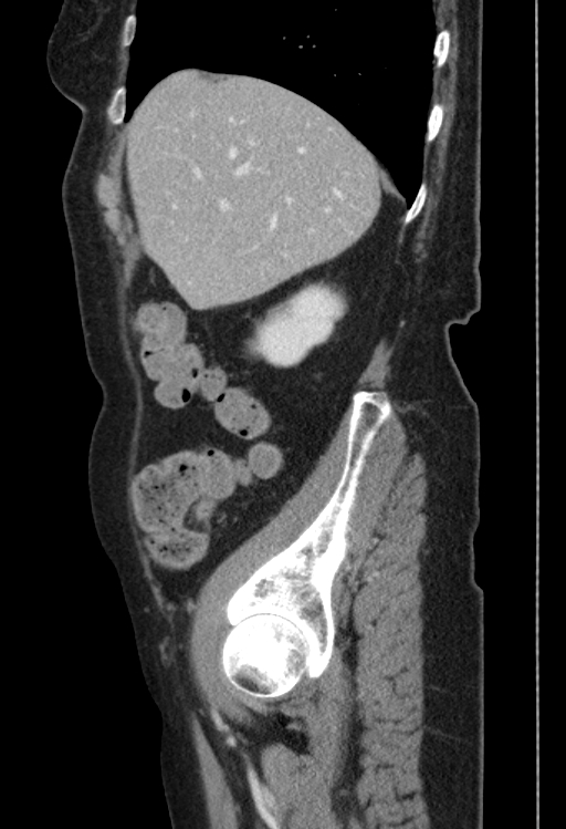 Cholecystoduodenal fistula due to calculous cholecystitis with gallstone migration (Radiopaedia 86875-103077 F 47).jpg