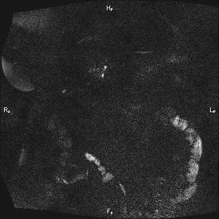 Choledochal cyst - type Ia (Radiopaedia 85673-101454 F 11).jpg