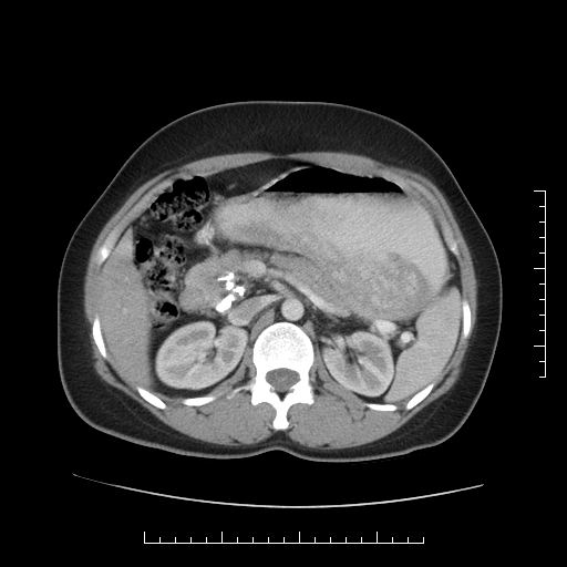 File:Choledochal cyst with chronic calcific pancreatitis (Radiopaedia 18245-18061 A 12).png