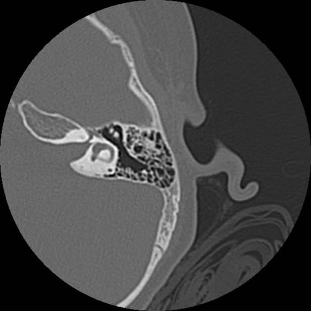 Cholesteatoma (Radiopaedia 73023-83750 Axial Left ear 49).jpg