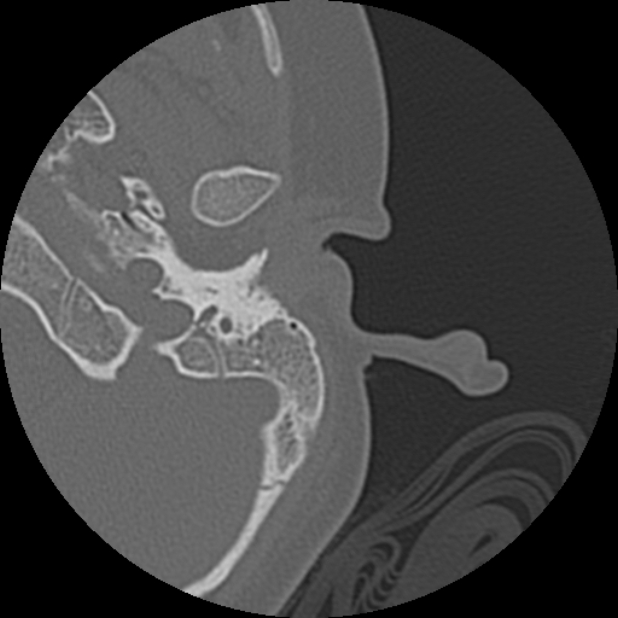 Cholesteatoma (Radiopaedia 73023-83750 Axial Left ear 6).jpg