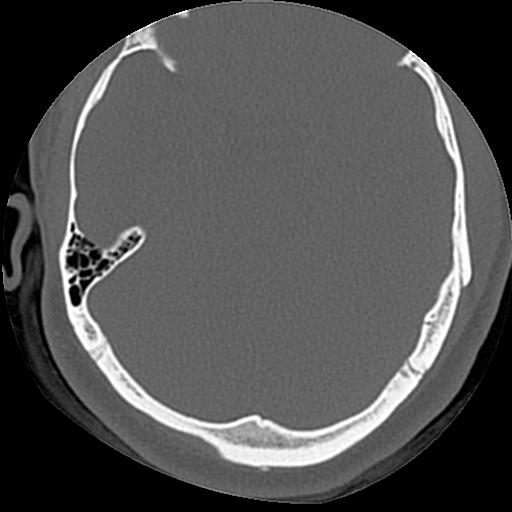 Cholesteatoma (Radiopaedia 84960-100474 Axial bone window 24).jpg