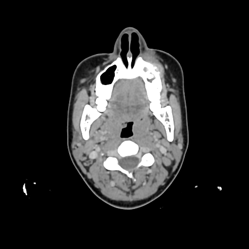 File:Chondroblastic osteosarcoma (Radiopaedia 67363-76741 Axial with contrast 25).jpg