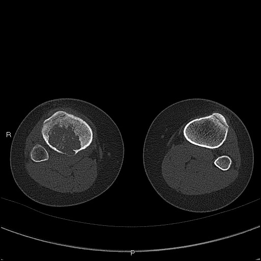 Chondroblastoma (Radiopaedia 62721-71030 Axial bone window 79).jpg