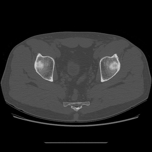 File:Chondrosarcoma of iliac wing (Radiopaedia 63861-72599 Axial bone window 90).jpg
