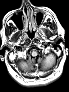 File:Chondrosarcoma of skull base- grade II (Radiopaedia 40948-43654 Axial T2 FLAIR 2).png