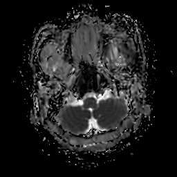 File:Chordoid glioma of third ventricle (Radiopaedia 91612-109340 Axial ADC 6).jpg