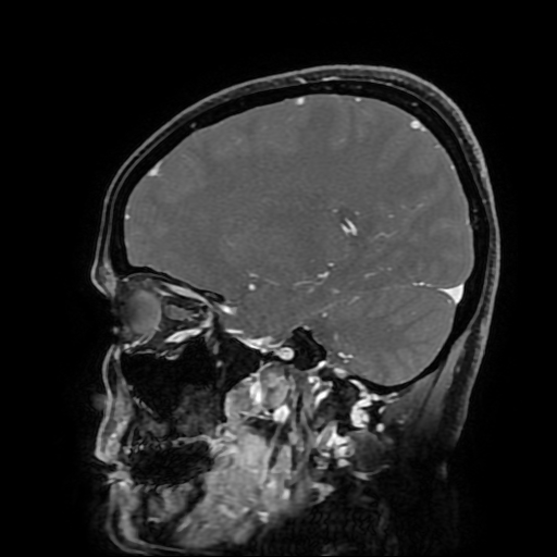 File:Chordoid glioma of third ventricle (Radiopaedia 91612-109340 F 80).jpg