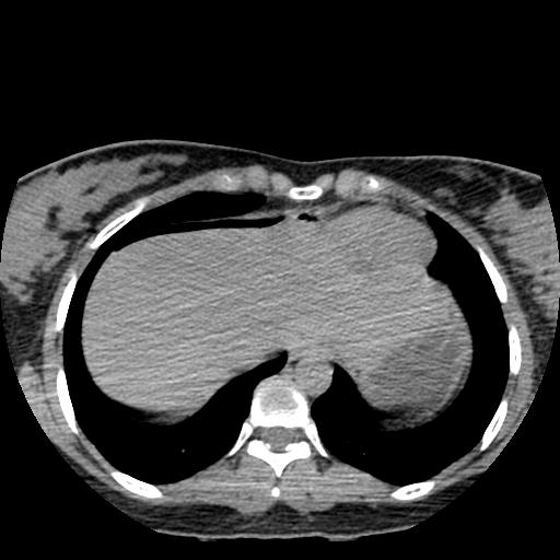 File:Choriocarcinoma of ovary with cerebral and pulmonary metastases (Radiopaedia 25983-26119 Axial non-contrast 29).jpg