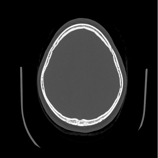 Choroid plexus papilloma extending into the cerebellopontine angle cistern (Radiopaedia 85941-101833 Axial bone window 71).png
