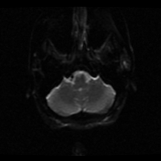 File:Choroid plexus xanthogranuloma (Radiopaedia 17650-17386 ADC 20).jpg