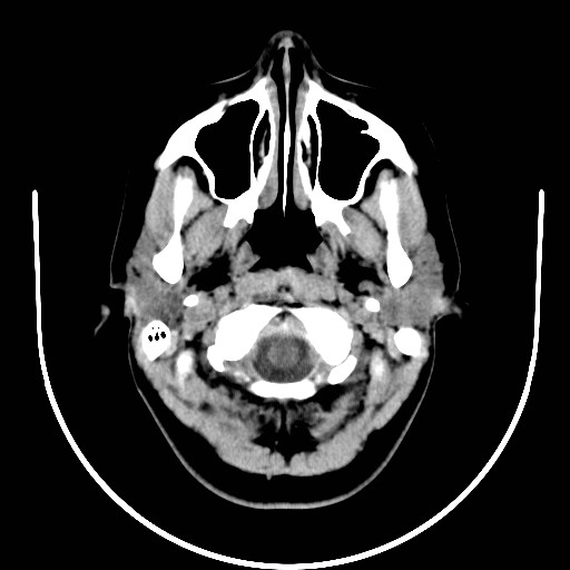 File:Choroidal fissure cyst (Radiopaedia 18711).jpg