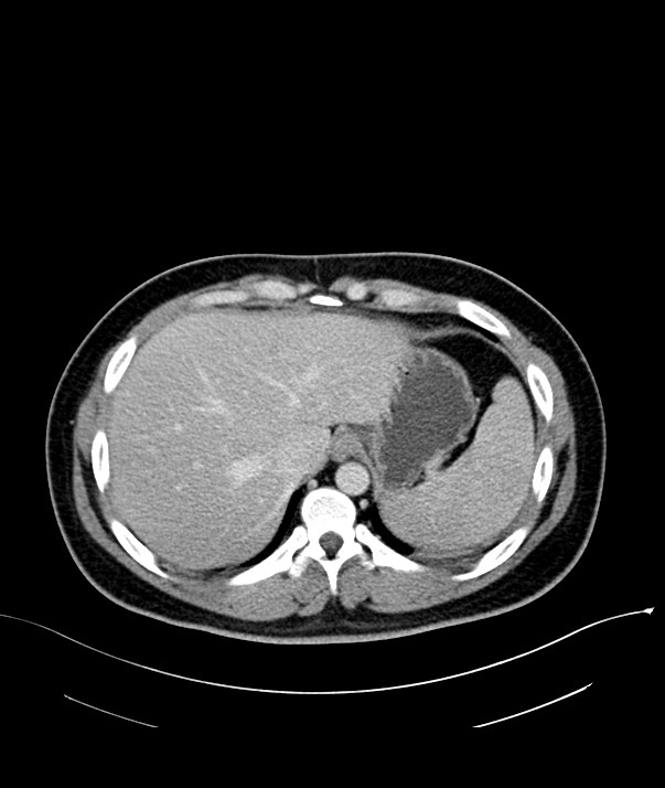 Chromophobe renal cell carcinoma (Radiopaedia 84255-99542 F 12).jpg
