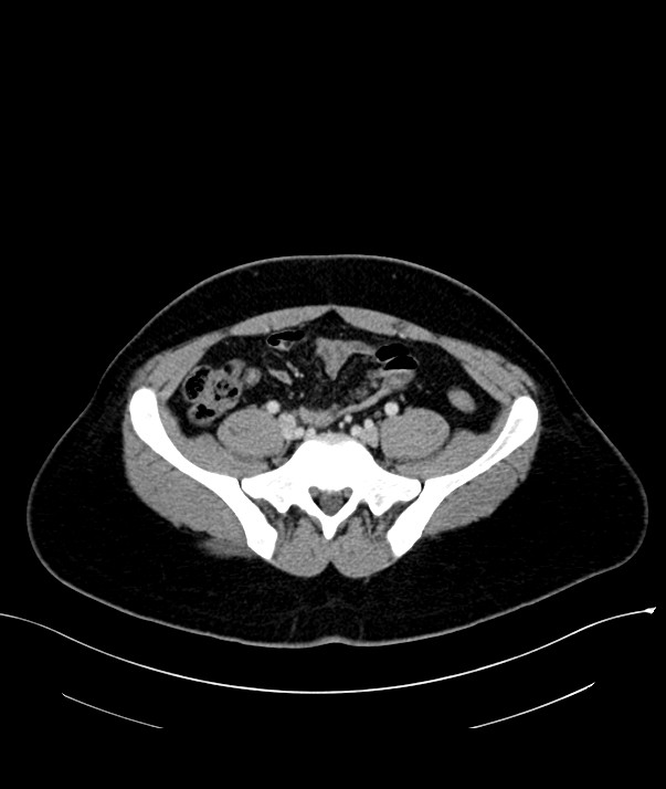 Chromophobe renal cell carcinoma (Radiopaedia 84255-99542 F 61).jpg