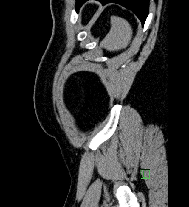 Chromophobe renal cell carcinoma (Radiopaedia 84286-99573 C 8).jpg