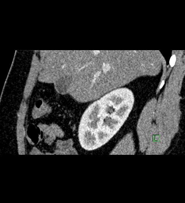 Chromophobe renal cell carcinoma (Radiopaedia 84286-99573 F 126).jpg