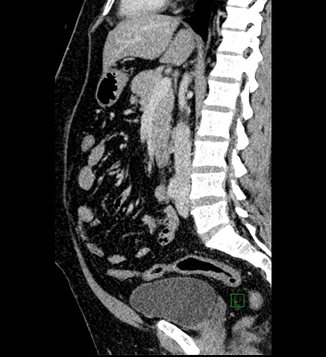 Chromophobe renal cell carcinoma (Radiopaedia 84286-99573 I 95).jpg