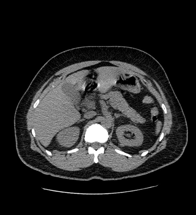 Chromophobe renal cell carcinoma (Radiopaedia 84337-99693 Axial non-contrast 39).jpg