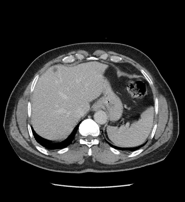 Chromophobe renal cell carcinoma (Radiopaedia 86879-103083 C 20).jpg