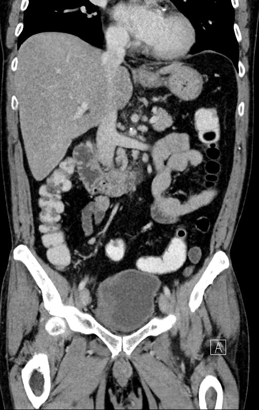 Chronic appendicitis complicated by appendicular abscess, pylephlebitis and liver abscess (Radiopaedia 54483-60700 C 38).jpg