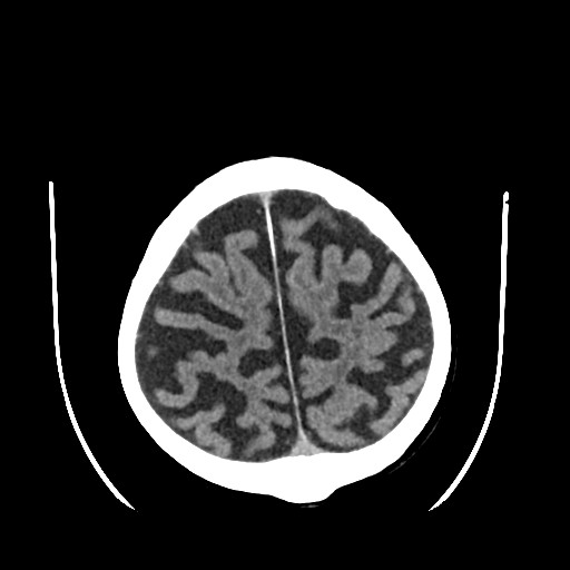 Chronic bilateral subdural hygroma (Radiopaedia 85801-101622 Axial non-contrast 59).jpg