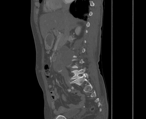 File:Chronic contained rupture of abdominal aortic aneurysm with extensive erosion of the vertebral bodies (Radiopaedia 55450-61901 Sagittal bone window 1).jpg