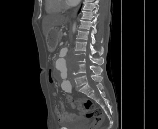 File:Chronic contained rupture of abdominal aortic aneurysm with extensive erosion of the vertebral bodies (Radiopaedia 55450-61901 Sagittal bone window 18).jpg