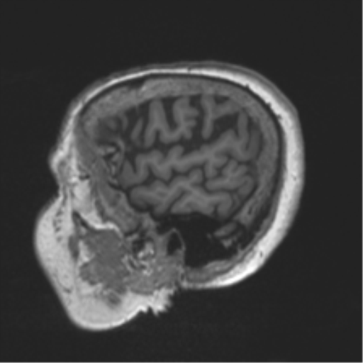 File:Chronic hypertensive encephalopathy (Radiopaedia 39993-42482 Sagittal T1 18).png