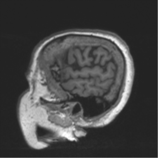 Chronic hypertensive encephalopathy (Radiopaedia 39993-42482 Sagittal T1 79).png